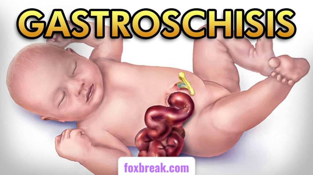 Gastroshiza Uncovered: Top Causes, Warning Signs, and Proven Treatments Gastroshiza